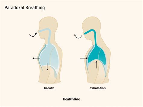 Paradoxical Breathing: Symptoms, Causes, and Treatments