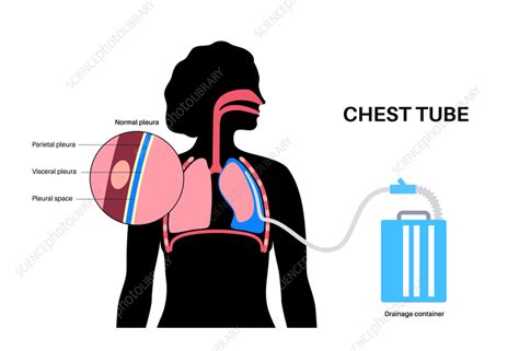 Chest tube catheter, illustration - Stock Image - F041/5940 - Science Photo Library