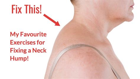 How to fix a neck hump at home fast – Artofit