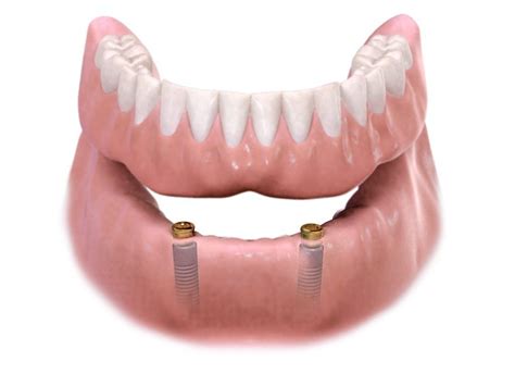 Overdenture | The best dental work and prices. Natural looking dental implants, bridges, crowns ...