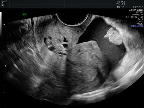 Diagnosing the Cause of and Measuring Cul-de-Sac Fluid | Empowered ...