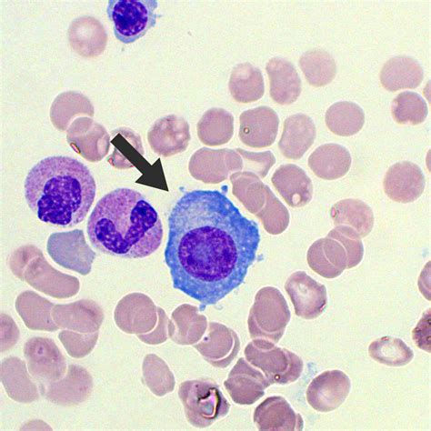 Circulating Plasma Cells | Blood Film - MedSchool