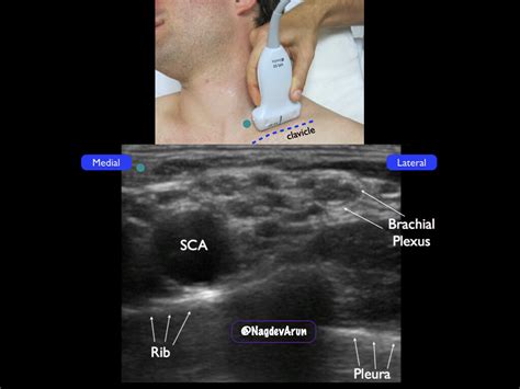 Supraclavicular Brachial Plexus — Highland EM Ultrasound Fueled pain management