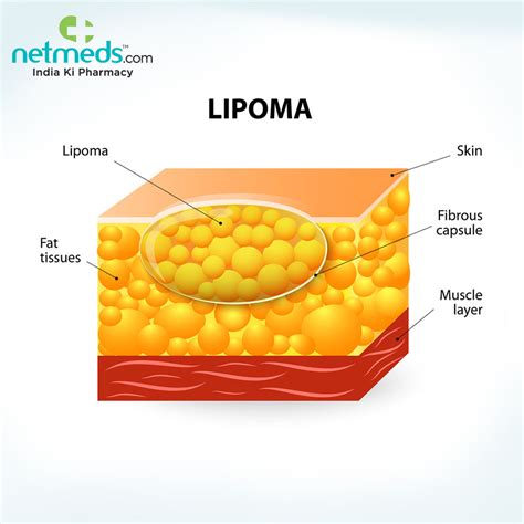 Lump under your skin? It could be a lipoma