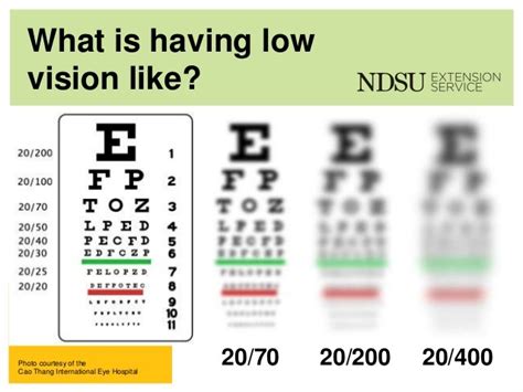 Symptoms: Vision Loss - Stargardt's Disease