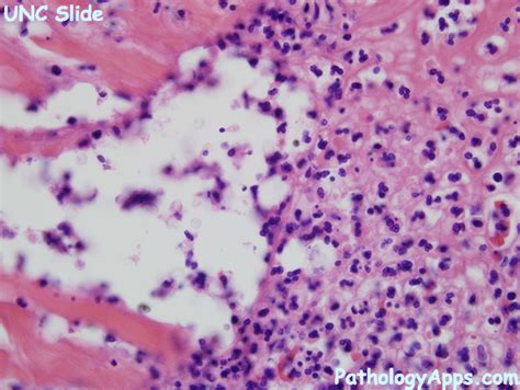 Cryptococcus On Gram Stain