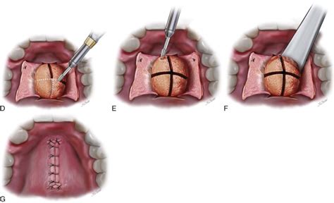 Torus Mandibularis Removal