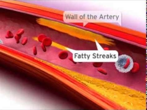 Fatty Streaks - YouTube