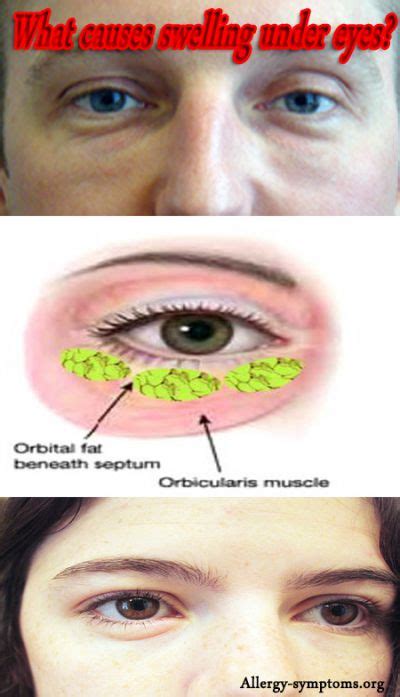 Periorbital Edema Causes and Treatment - Allergy-symptoms.org