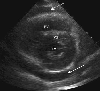 Ultrasound Artifacts | Radiology Key