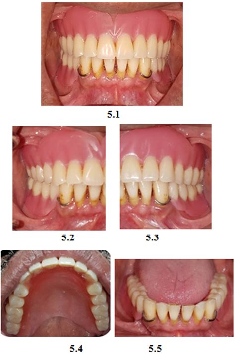 Figure 5. : Tooth Supported Overdenture as an Amazing Solution for the Patient: A Case Report ...