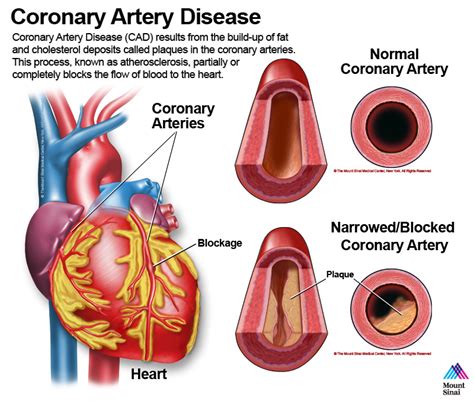 Ask Pharmacy: New Treatment Guidelines For Hypertension