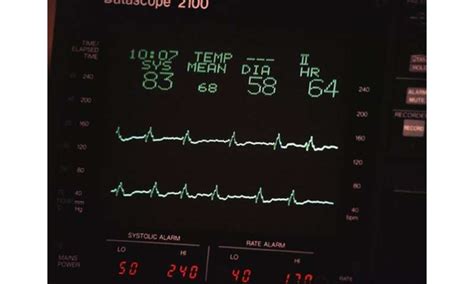 Most ICU patient alarms not clinically accurate or relevant