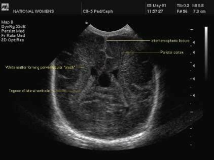 Neonataler Kopf Ultraschall