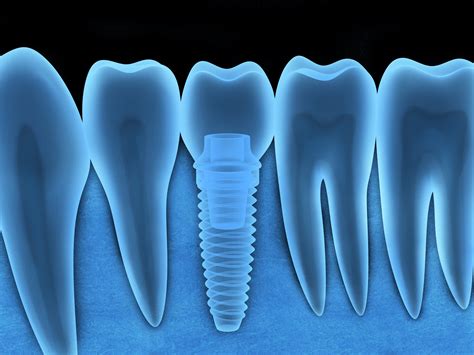 Dental implant x-ray - Maison Smile