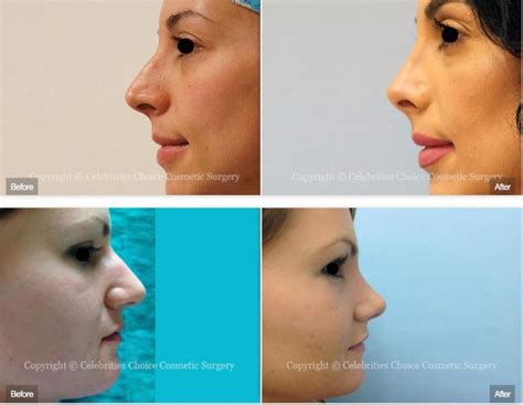 NASAL TIP AND UPPER LIP LIFT - Options Best Plastic Surgeon Orlando