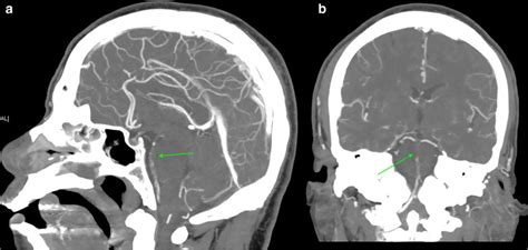 Basilar artery occlusion (arrows) visualized on the CTA, sagittal (a)... | Download Scientific ...