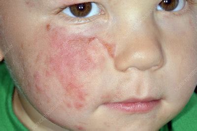 Cellulitis of the face - Stock Image - C026/3286 - Science Photo Library