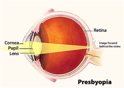 Presbyopia: Causes, Symptoms and Treatment | EyeMantra
