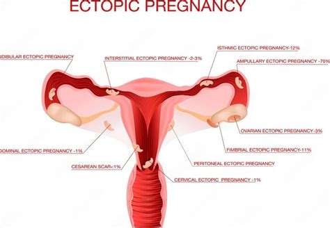 Ectopic Pregnancy Symptoms, Causes & Treatment - Dr. Mona