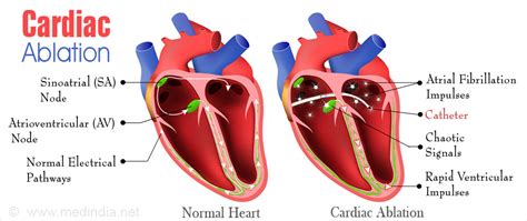 Atrial flutter ablation success rate - chemDer