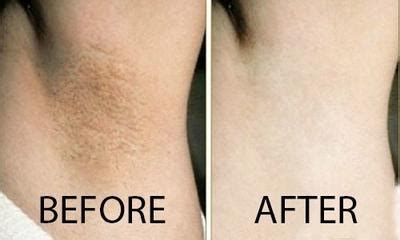 Underarm Whitening Treatment | Wellness Today