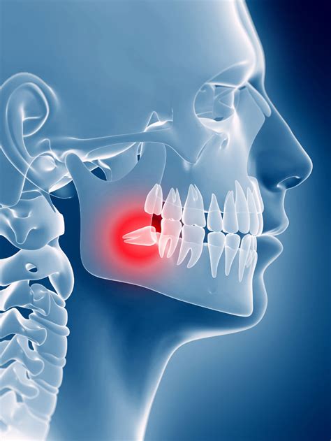 Wisdom Teeth Stitches Dissolve