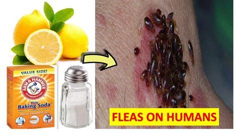 How to get rid of fleas on humans the easy and inexpensive way – Natural... | Health, Human, How ...