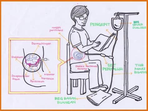 Comprehensive Guide to Peritoneal Dialysis: Procedure, Benefits, and Myths Clarified - The ...