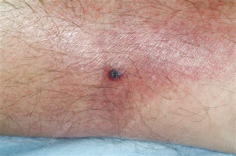 Infected horsefly bite on the leg - Stock Image - C008/5588 - Science ...