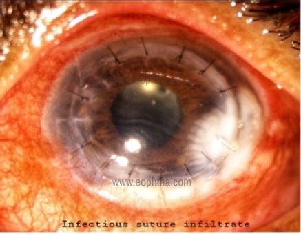 Complications of Penetrating Keratoplasty