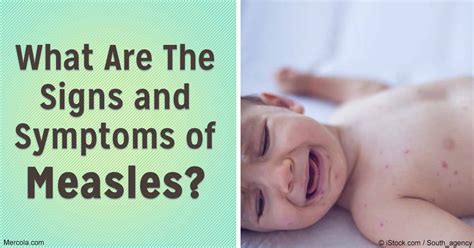 What Are The Signs and Symptoms of Measles?