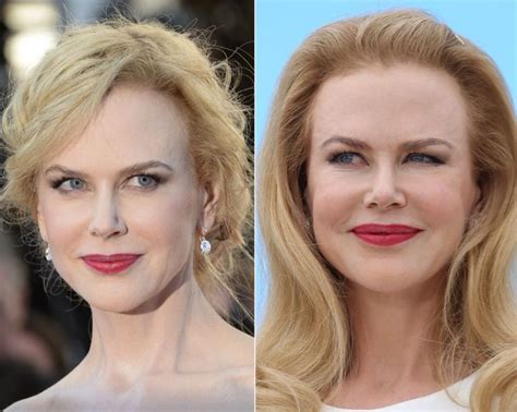 Nicole Kidman before and after plastic surgery (21) | Celebrity plastic surgery online