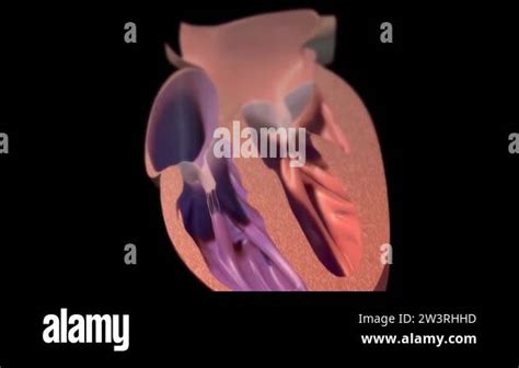 It means respiratory failure due to heart failure, edema, growth in the liver and obvious ...