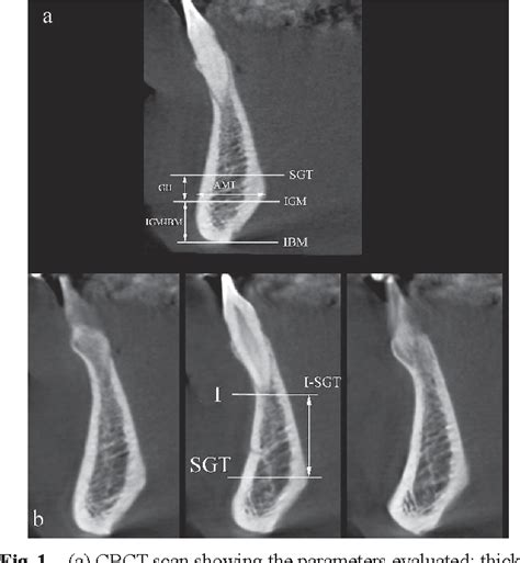 Figure 1 from Evaluation of genial tubercle anatomy using cone beam ...