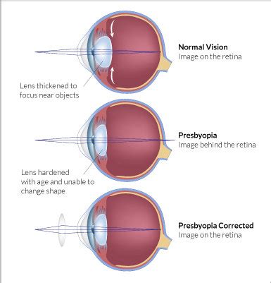 What is Presbyopia | Glasses Gallery | Eye care information