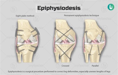 Epiphysiodesis: Procedure, Purpose, Results, Cost, Price, Indications, Recovery