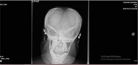 Skull X-ray (Case 1). | Download Scientific Diagram