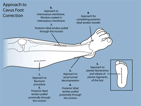 Treatment Strategies - Paley Orthopedic & Spine Institute