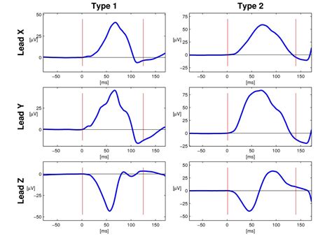 Age-related changes in P wave morphology in healthy subjects | BMC ...