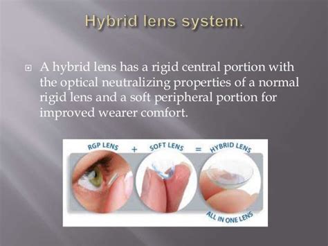 Contact lens fitting in keratoconus copy