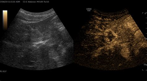 Hepatic hemangioma - contrast enhanced ultrasound | Image | Radiopaedia.org