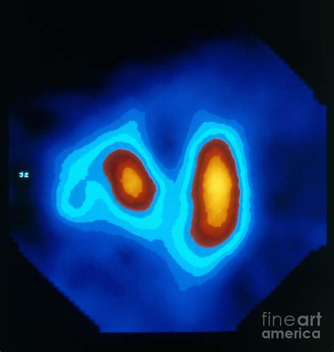 S.p.e.c.t. Scan Of Renal Artery Stenosis Photograph by Oullette/Theroux/Publiphoto - Fine Art ...