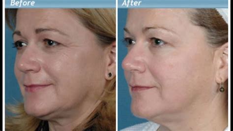 Anti Wrinkle Cream - Before and After - YouTube