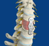 Cervical Corpectomy - Spine & Orthopedic Center