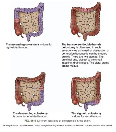 153 best images about Colostomy Info on Pinterest | Awareness campaign, Bags and Appliances