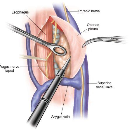 Mediastinal Node Dissection Right/Left (VATS/Open) | Thoracic Key