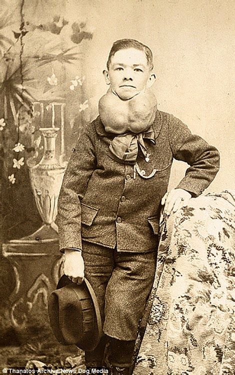 Photographic archive of 19th century deformities released | Daily Mail Online