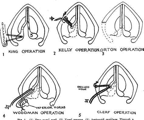 Figure 1 from Laryngeal paralysis with a review of its treatment. | Semantic Scholar