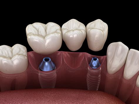 The 3 Main Types of Dental Implant Restorations